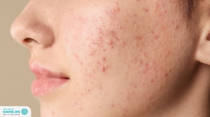 Cách trị mụn ẩn tại nhà hiệu quả sau 1 tuần thực hiện