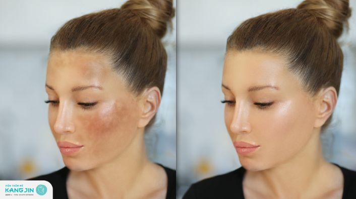 Cách trị tàn nhang tận gốc hiệu quả, vĩnh viễn không tái lại