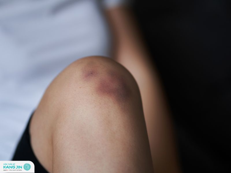 cách trị thâm đầu gối