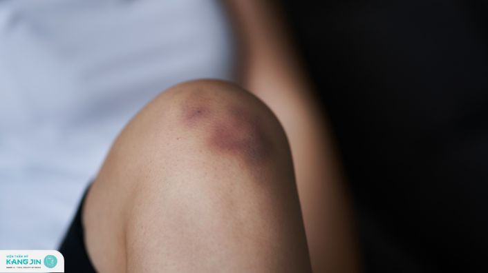 cách trị thâm đầu gối