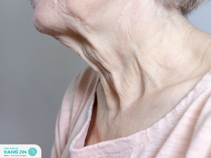 Các dấu hiệu lão hóa da cổ ngày càng rõ rệt khi tuổi tăng lên