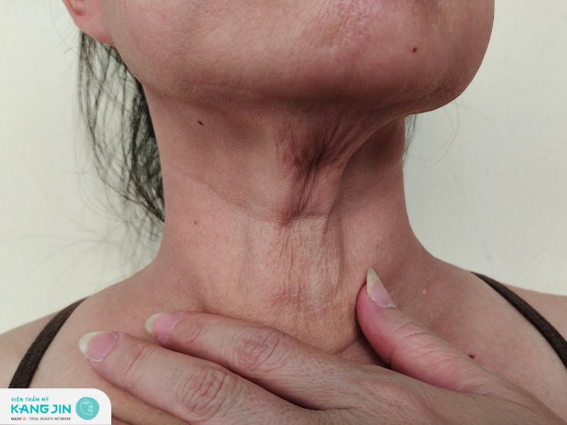 Lão hóa da cổ: Dấu hiệu nhận biết và cách ngăn ngừa 