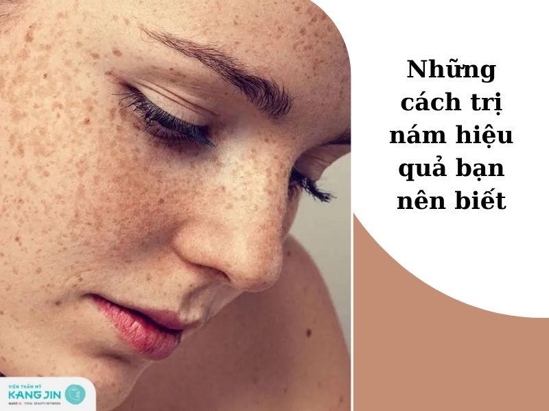 cách trị nám hiệu quả