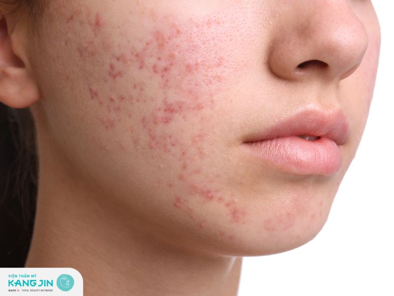 Tác dụng khi xông mặt trị mụn ẩn 