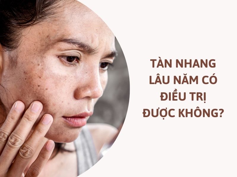 cách trị tàn nhang