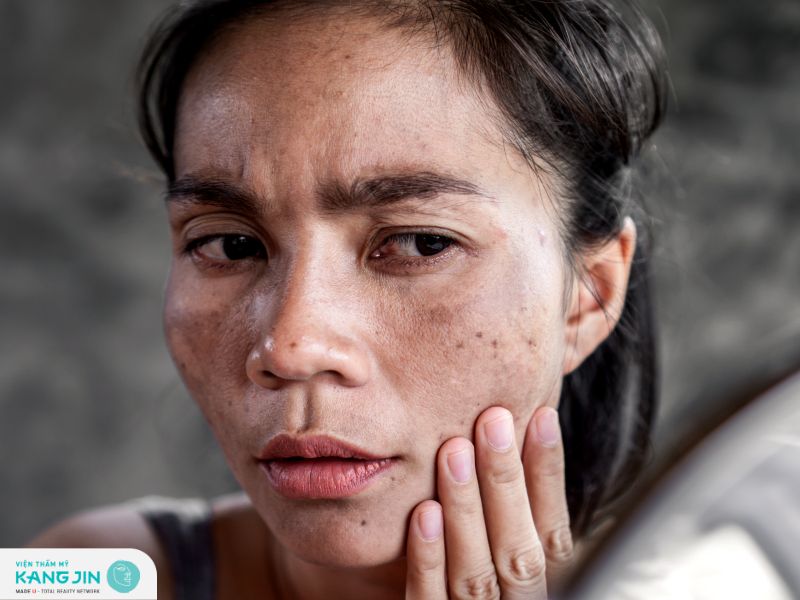 Điều trị nám và tàn nhang lâu năm có thể phụ thuộc vào nhiều yếu tố