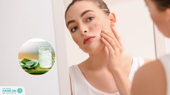 Cách trị mụn bằng nha đam giúp da láng mịn, ngừa viêm hiệu quả