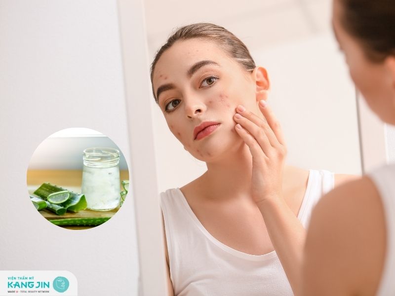 Hướng dẫn cách trị mụn bằng nha đam hiệu quả mà không gây kích ứng da tại nhà 