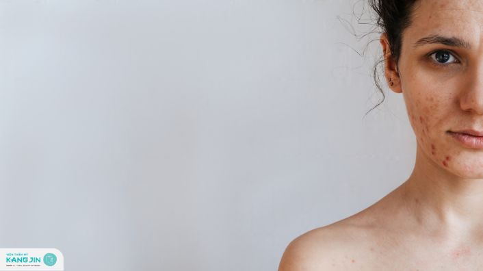 trị thâm mụn trong 7 ngày