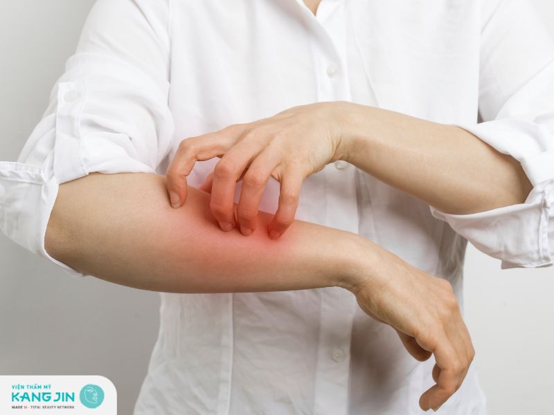 Viêm da dị ứng: Nguyên nhân và cách điều trị hiệu quả
