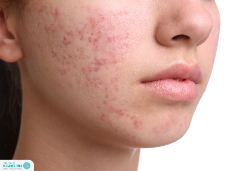 cách trị mụn nội tiết dứt điểm