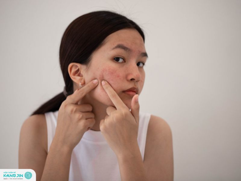 cách trị mụn nội tiết dứt điểm