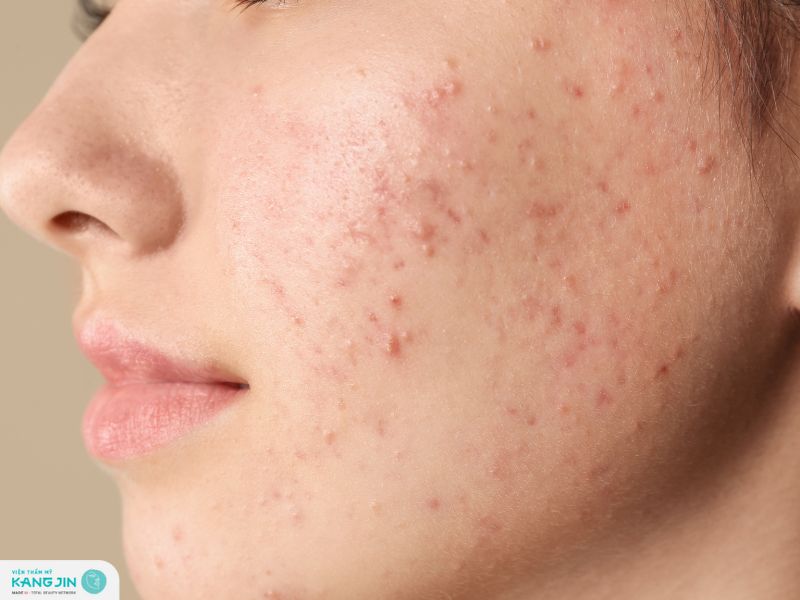 những lưu ý khi trị mụn nội tiết