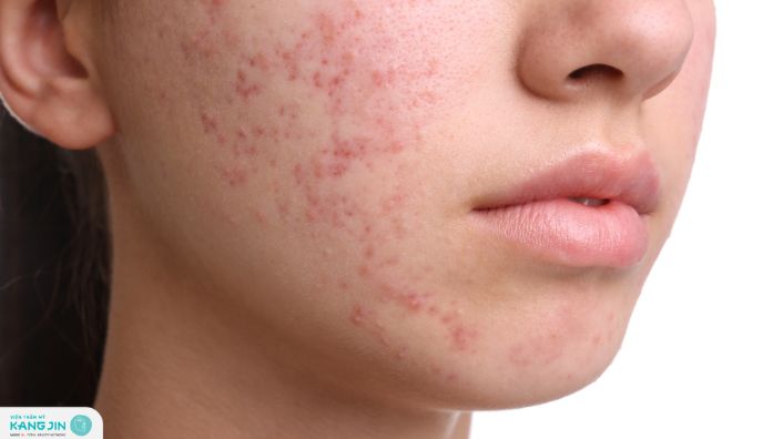 cách trị mụn nội tiết dứt điểm