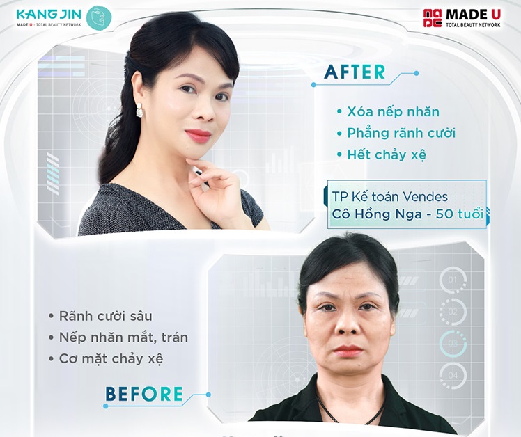 Khách hàng sau khi xóa nhăn ấn đường bằng MaxCollagen Diamond