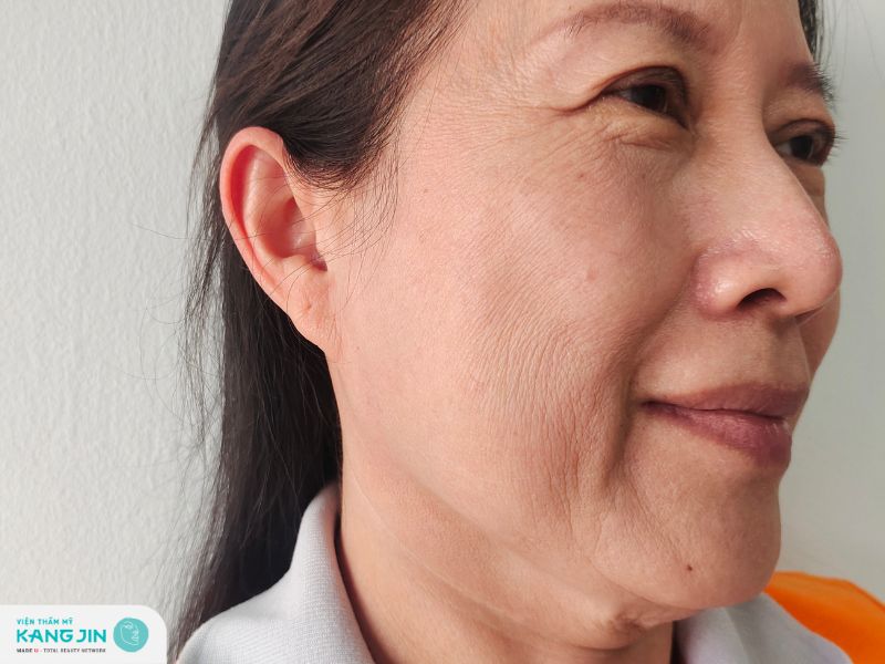 nếp nhăn khóe miệng