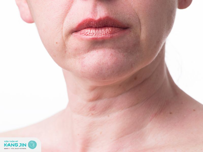 nếp nhăn ở cổ