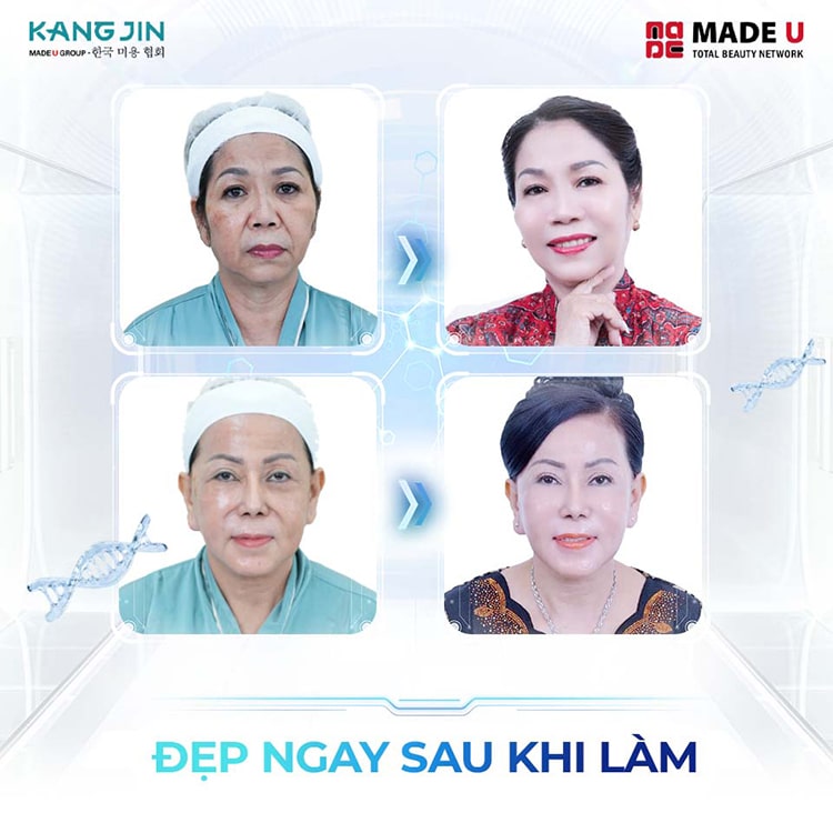 kết quả sau khi xóa nếp nhăn trán tại Viện thẩm mỹ KangJin