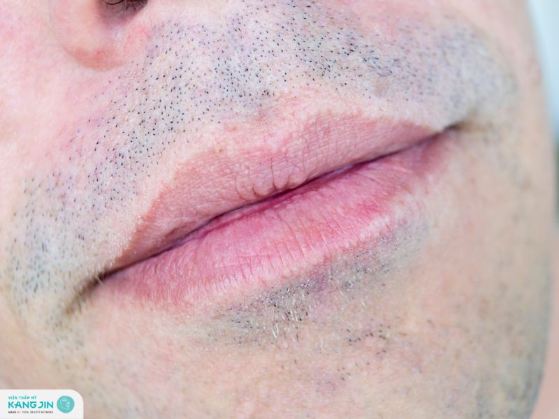 trị thâm môi cho nam