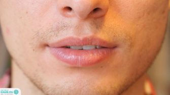 5 cách trị thâm môi cho nam tại nhà hiệu quả nhanh