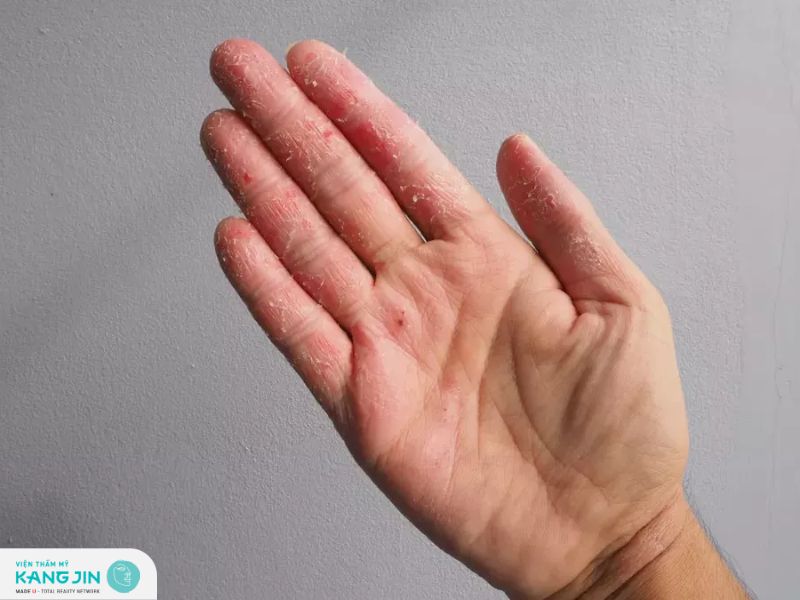 Bong da đầu ngón tay - Dấu hiệu của bệnh gì?