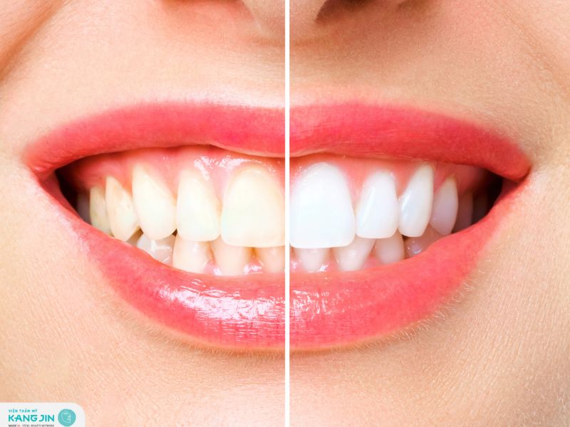 cách làm trắng răng