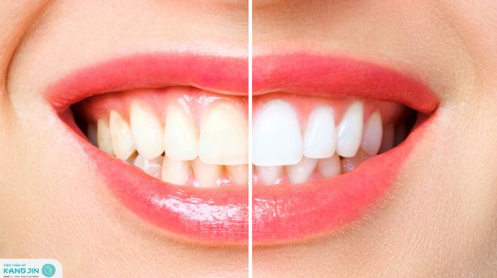 cách làm trắng răng