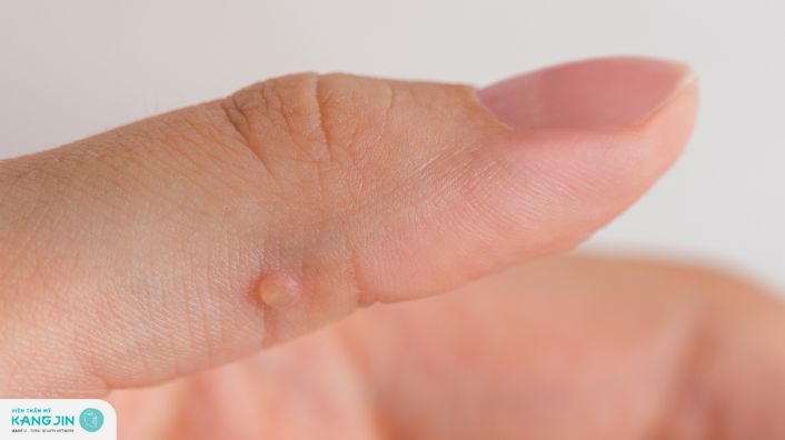 Mụn cóc là gì? Cách trị mụn cóc từ mẹo dân gian an toàn cho da