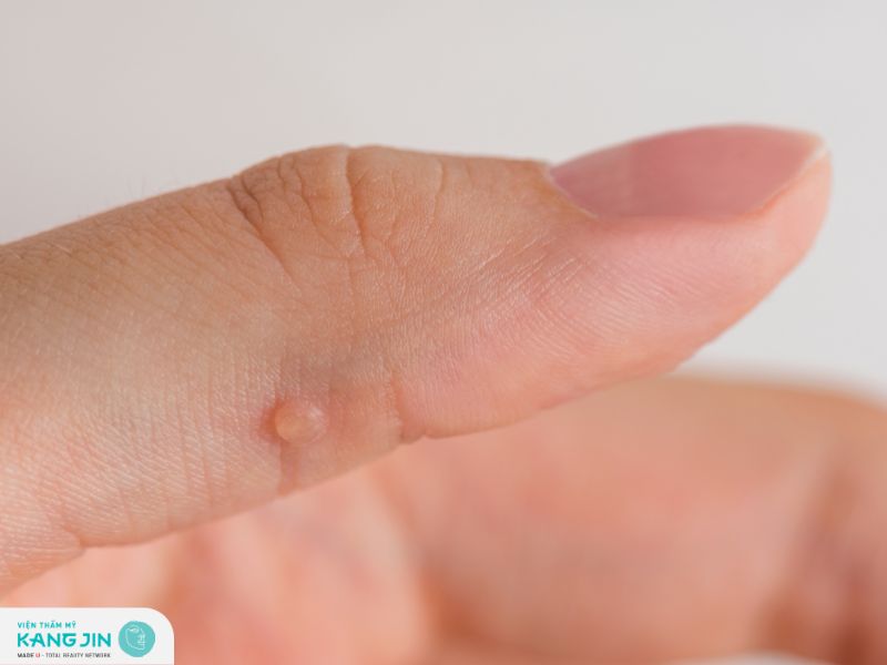 Khái niệm mụn cóc và cách trị mụn cóc hiệu quả tại nhà