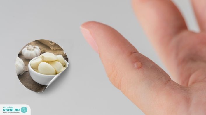 Cách trị mụn cóc bằng tỏi tại nhà có hiệu quả như lời đồn