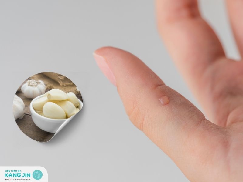 Hướng dẫn cách trị mụn cóc bằng tỏi nhanh chóng 