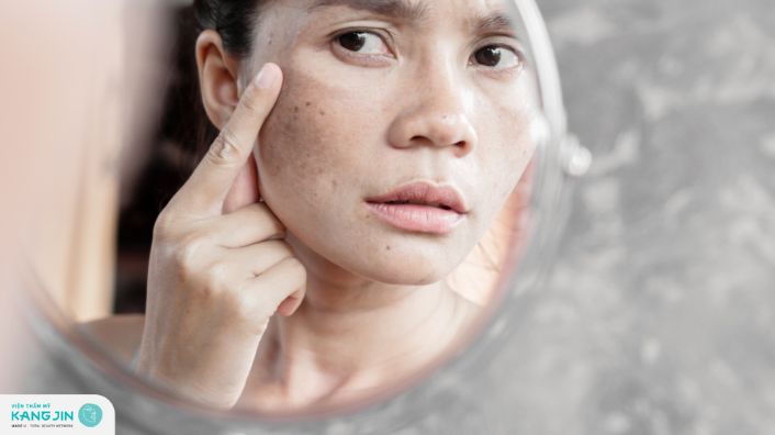 Bật mí 6 cách trị nám tại nhà hiệu quả bằng các phương pháp tự nhiên