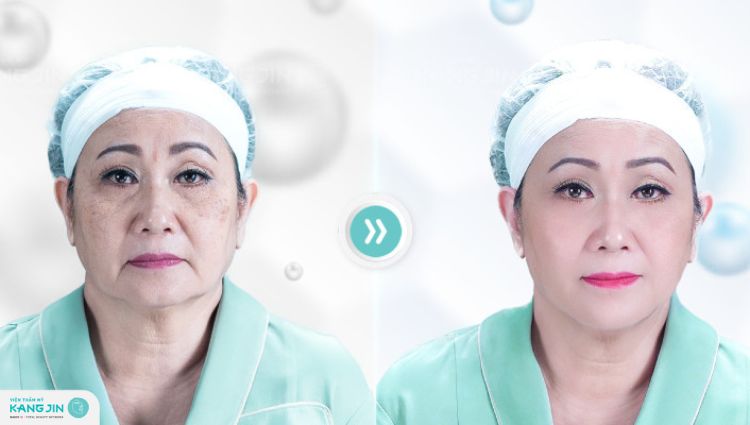 trị nám bằng liệu pháp KangJin MaxCollagen Diamond Siêu Vi Điểm