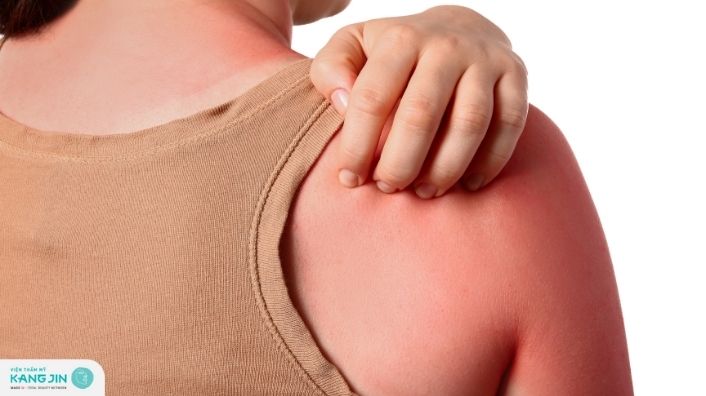 Da cháy nắng: Nguyên nhân , cách chữa và biện pháp phòng ngừa