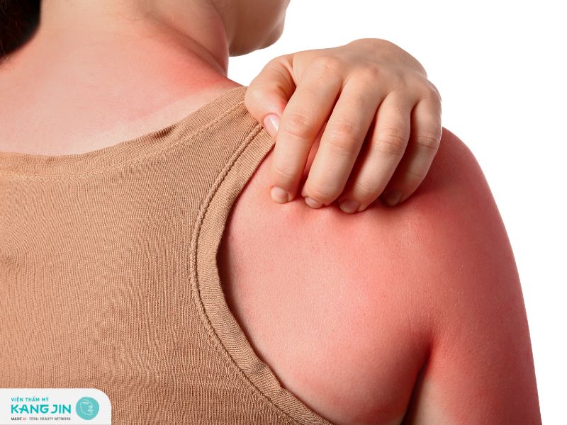 Nguyên nhân khiến da bị cháy nắng và cách phục hồi tại nhà 