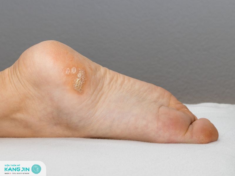 Dấu hiệu nhận biết mụn cóc mà bạn nên biết