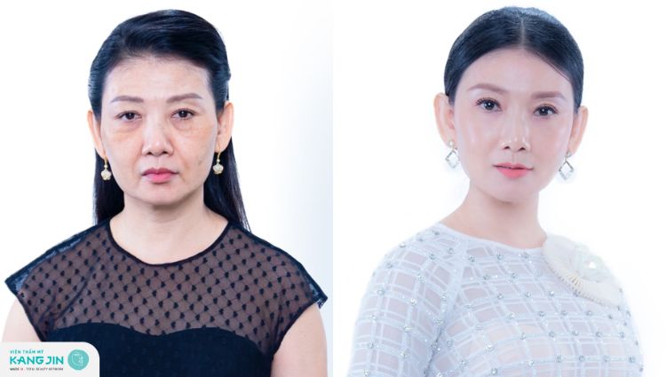 trẻ hóa kangjin maxcollagen diamond siêu vi điểm có đắt không