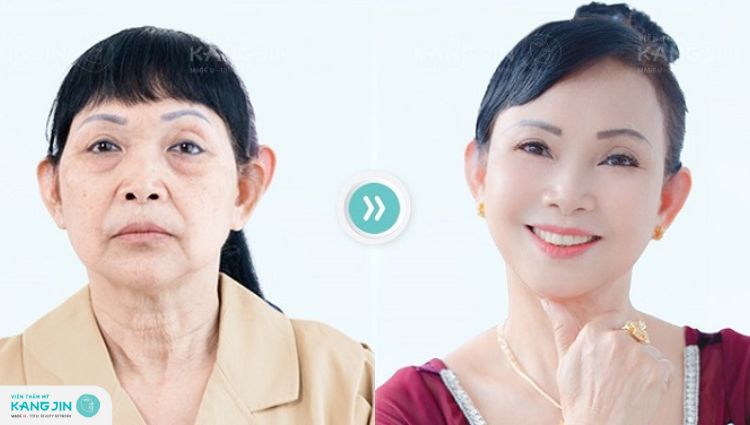 giá trẻ hóa tại viện thẩm mỹ kangjin