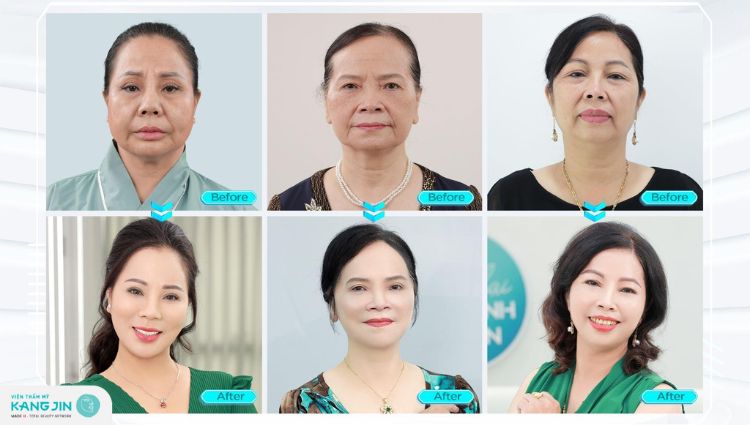 giá trẻ hóa tại viện thẩm mỹ kangjin