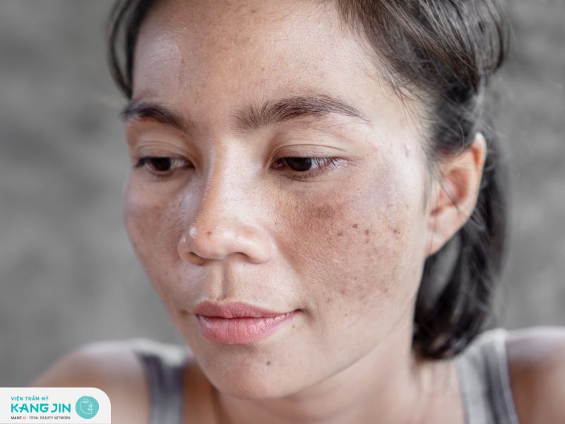 Bị nám da có điều trị được không?