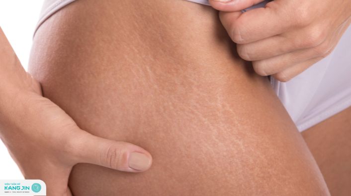 rạn da đùi