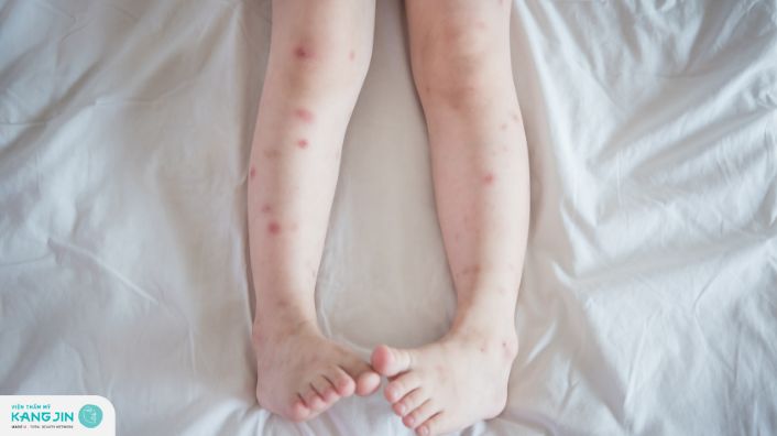 Tổng hợp các cách trị thâm hiệu quả mà bạn nên biết