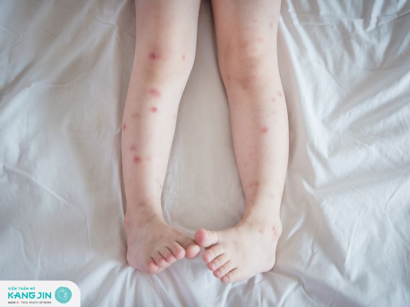 Các cách trị thâm chân hiệu quả tại nhà