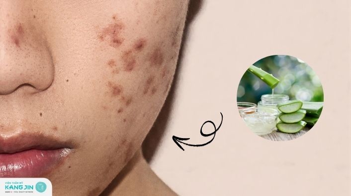 Bật mí 7 cách trị thâm mụn bằng nha đam tươi tại nhà