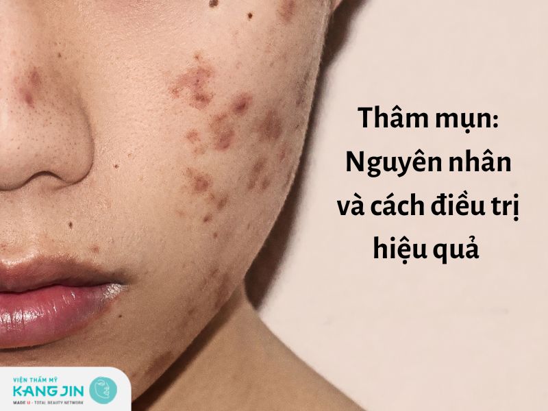 Thâm mụn: Nguyên nhân và cách điều trị hiệu quả an toàn