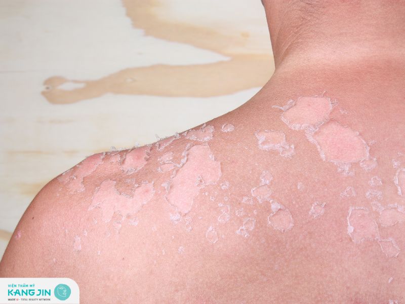 Các triệu chứng khi da cháy nắng mà bạn nên biết 