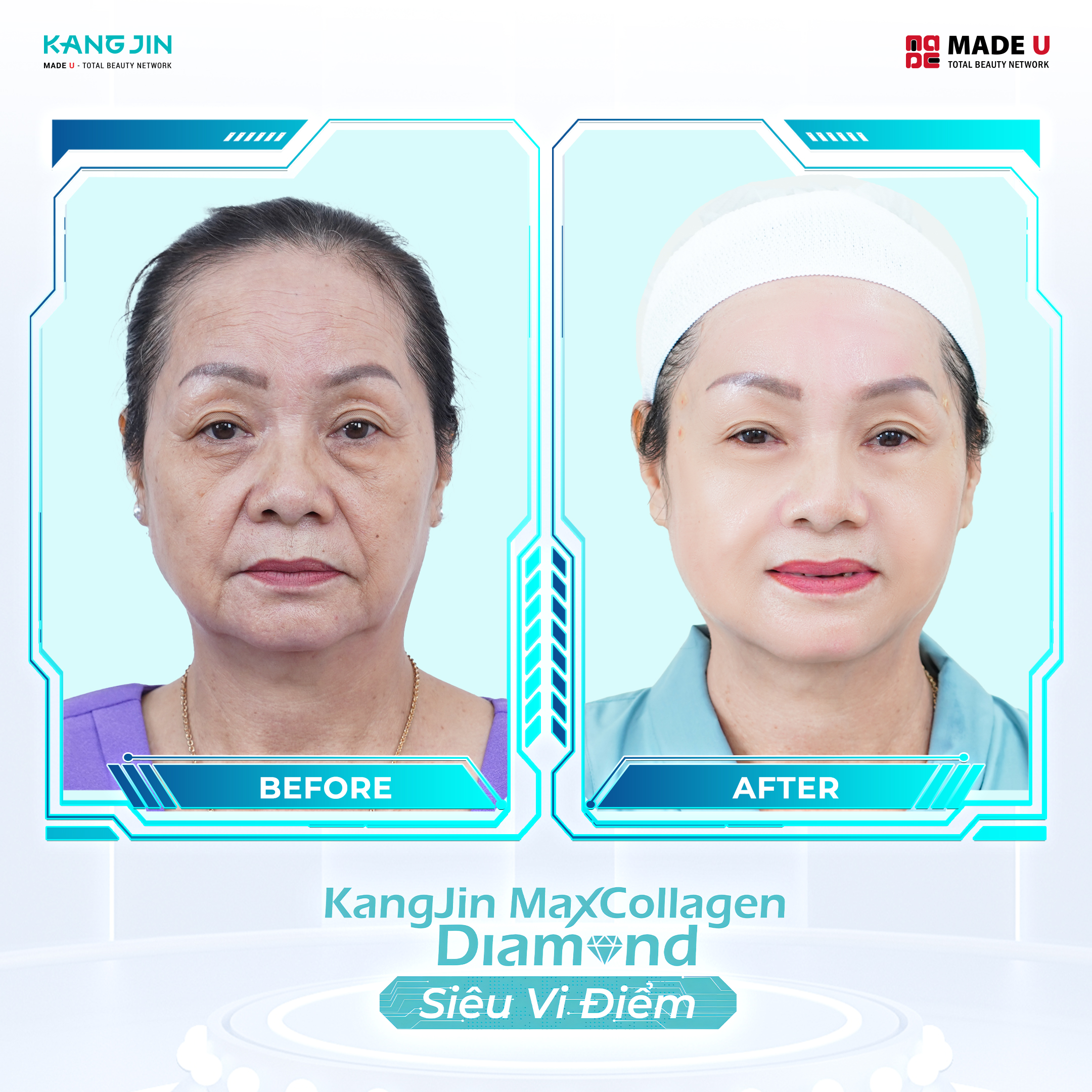 hình ảnh trước và sau khi làm liệu trình KangJin MaxCollagen Diamond Siêu Vi Điểm