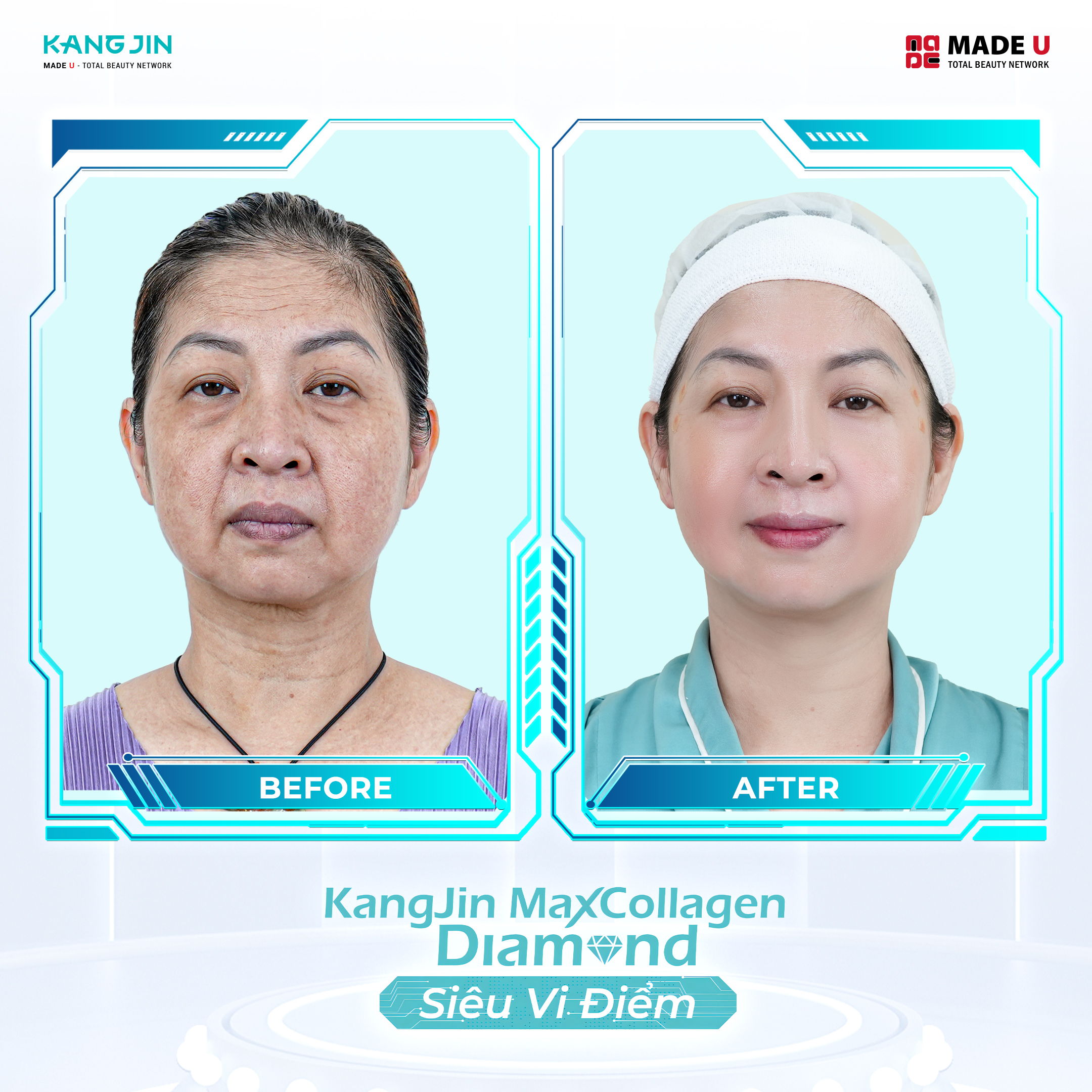 Khách hàng trẻ hóa thành công nhờ bàn tay phù thủy của BS Tiến