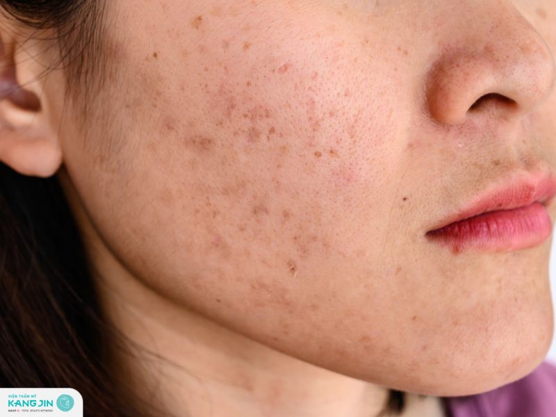 nguyên nhân gây ra nám