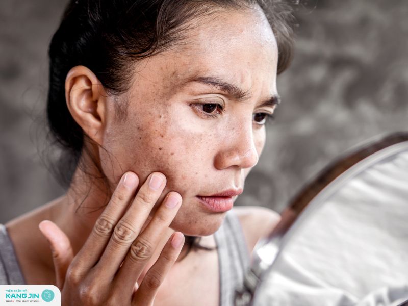 cách chăm sóc da bị nám